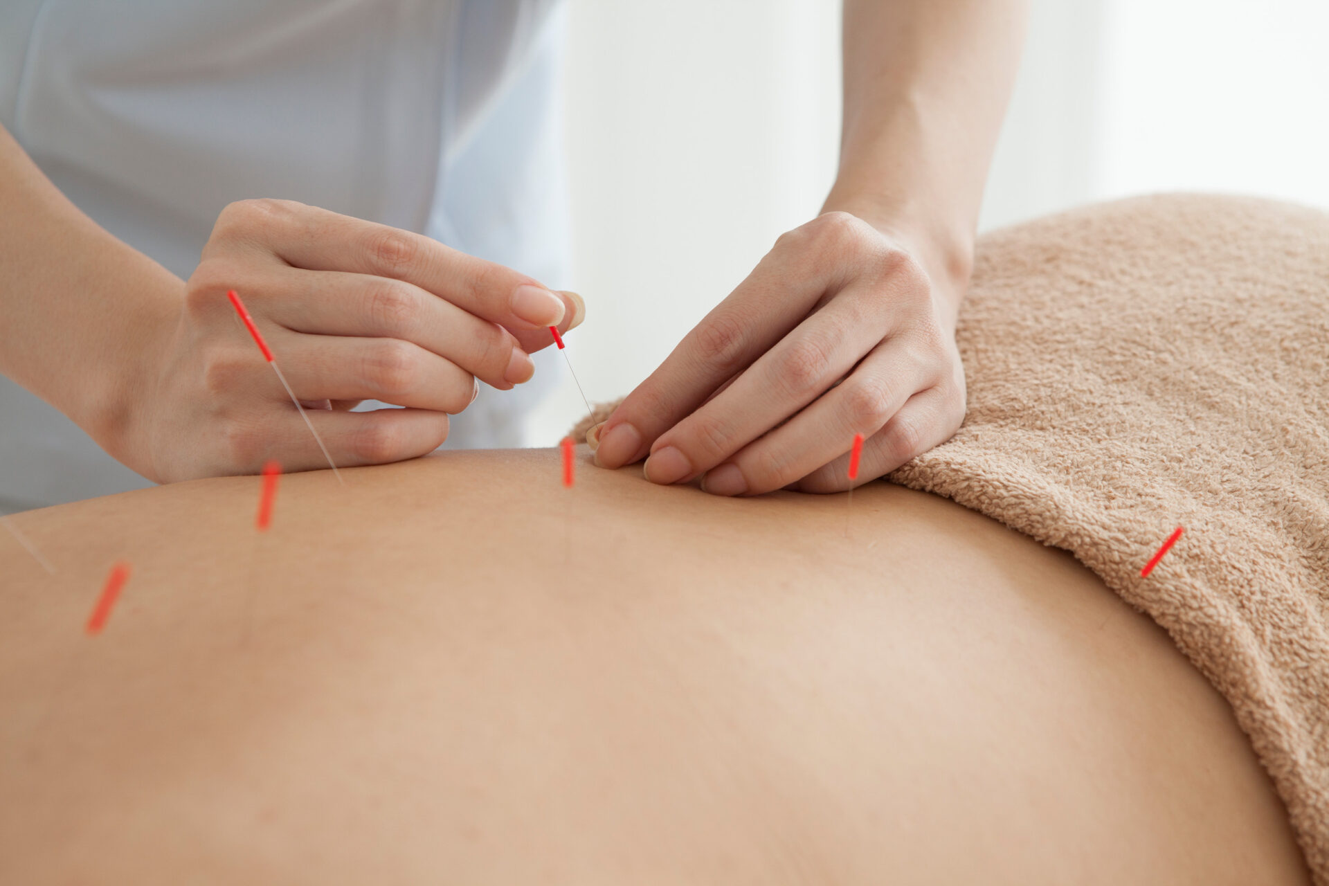 Acupuncture for Chronic Pain