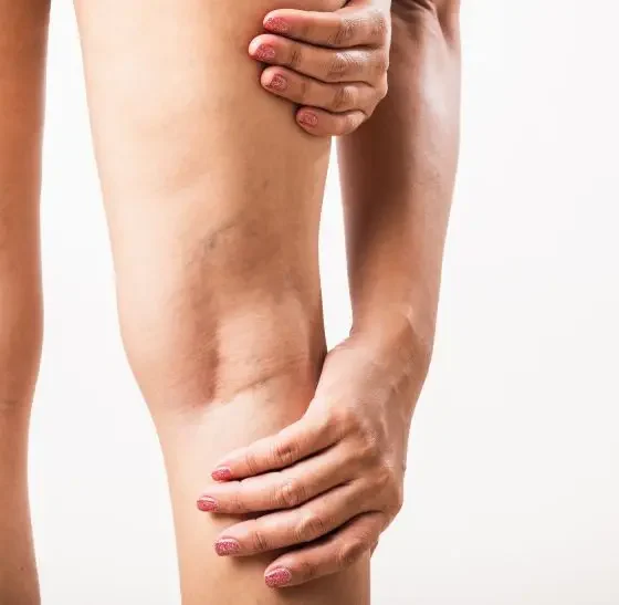 Exploring Non-surgical Options for Varicose Veins