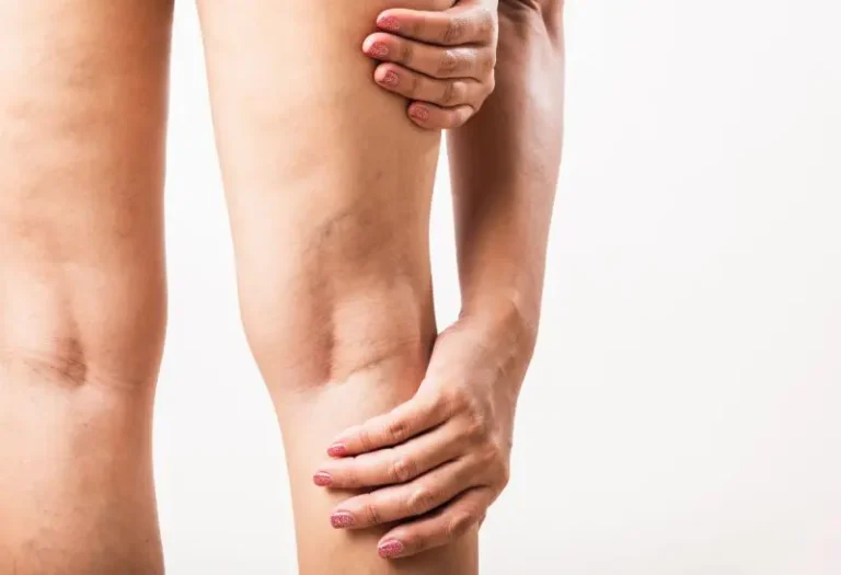 Exploring Non-surgical Options for Varicose Veins