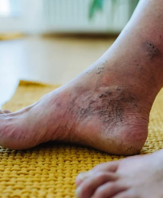 How Can a Podiatrist Help With Diabetes Care?