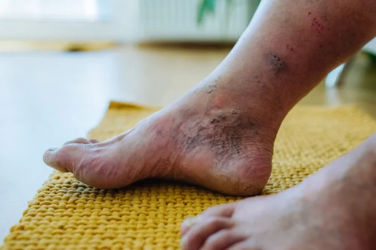 How Can a Podiatrist Help With Diabetes Care?