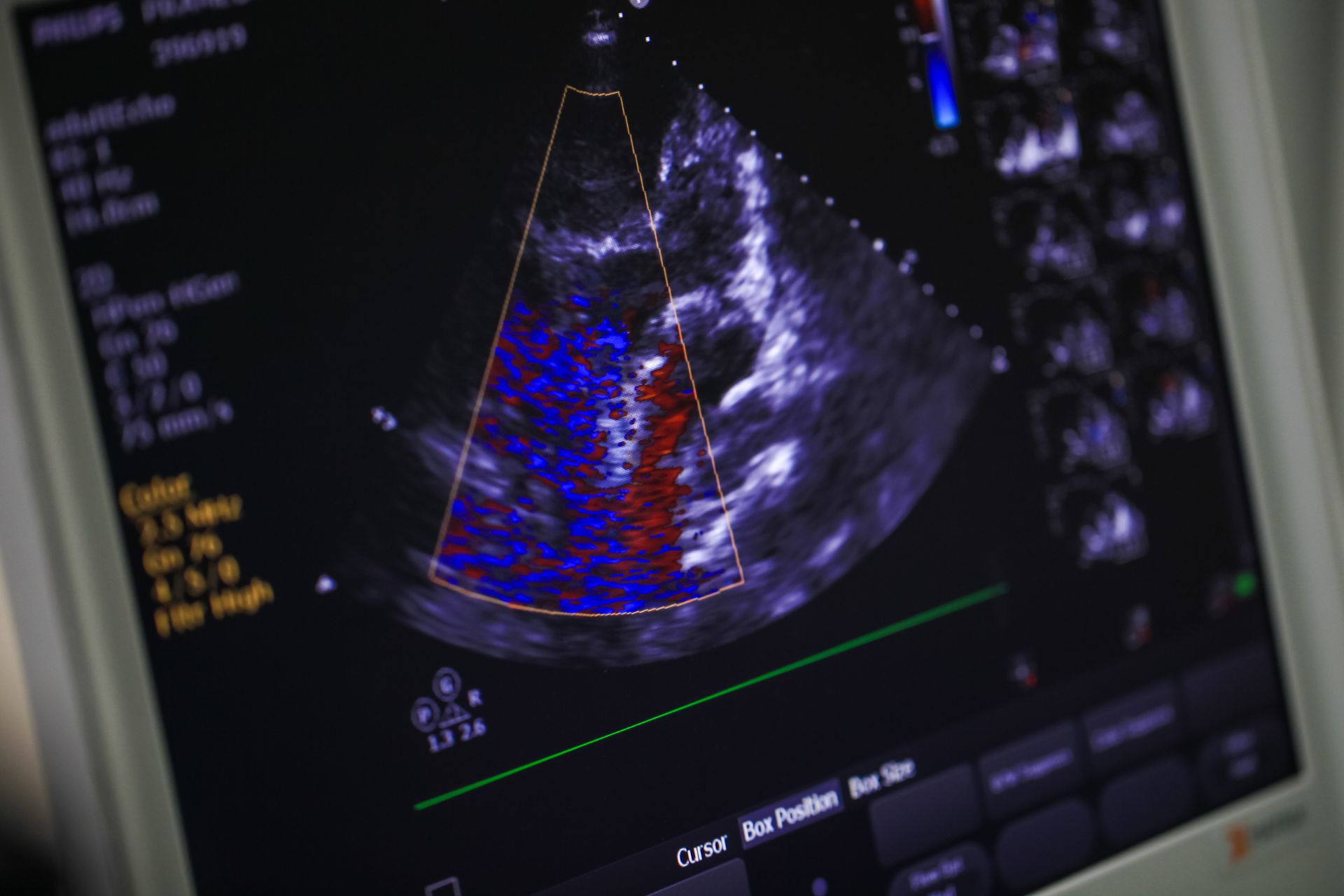 How Cardiologists Use Echocardiograms for Heart Health Diagnosis