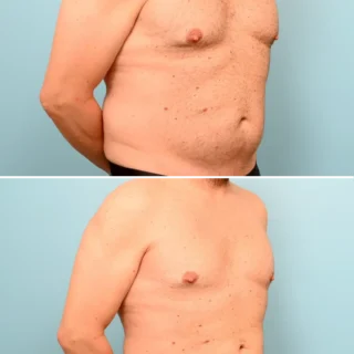 Long-Term Effects of Gallbladder Removal