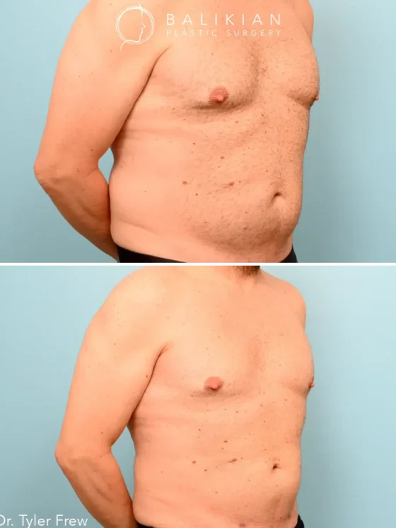 Liposuction for Older Adults
