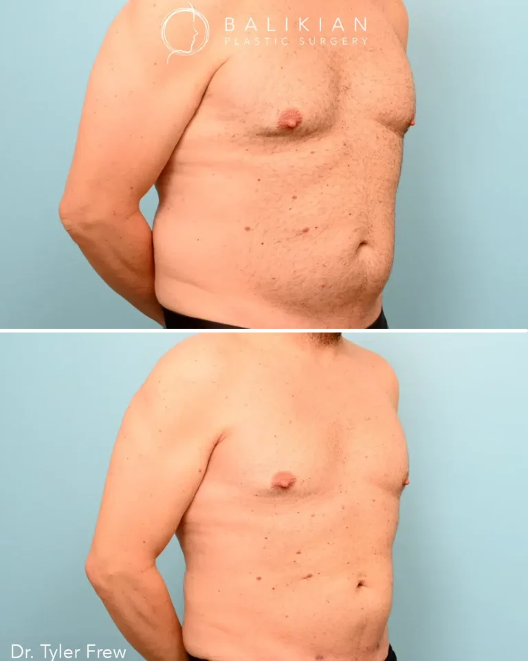 Liposuction for Older Adults
