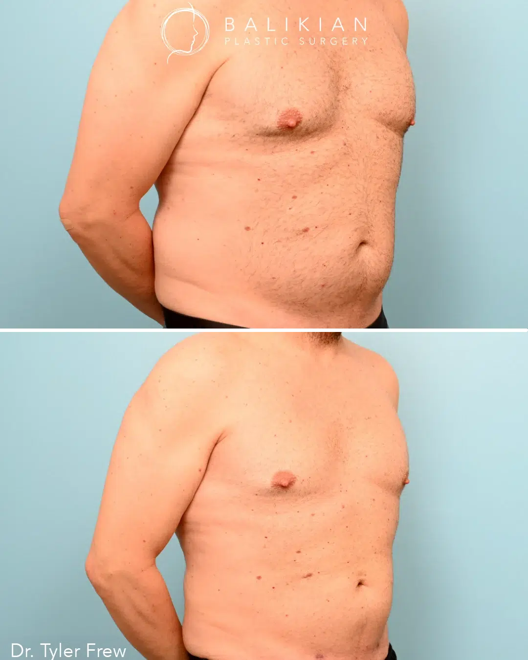 Liposuction for Older Adults