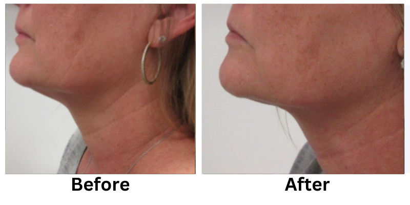 Long-term Laser Hair Removal Results