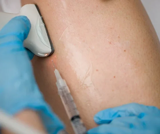 The Connection Between Lifestyle and Varicose Veins