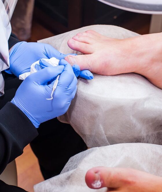 The Role of a Podiatrist in Managing Ingrown Toenails