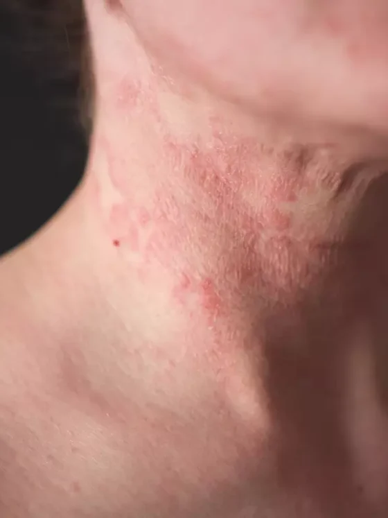 Understanding When To See a Skin Doctor for Persistent Rashes