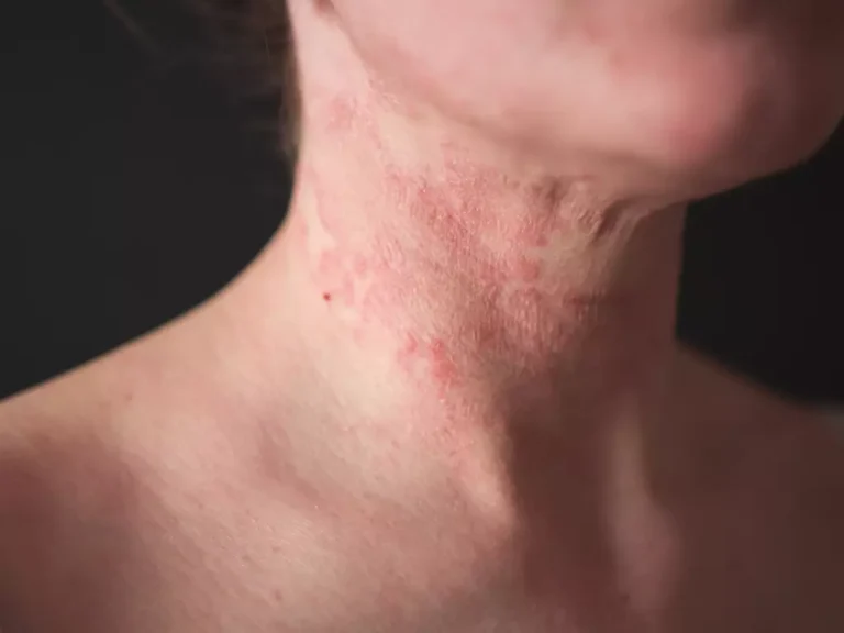Understanding When To See a Skin Doctor for Persistent Rashes