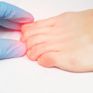 How Microneedling Addresses Skin Concerns