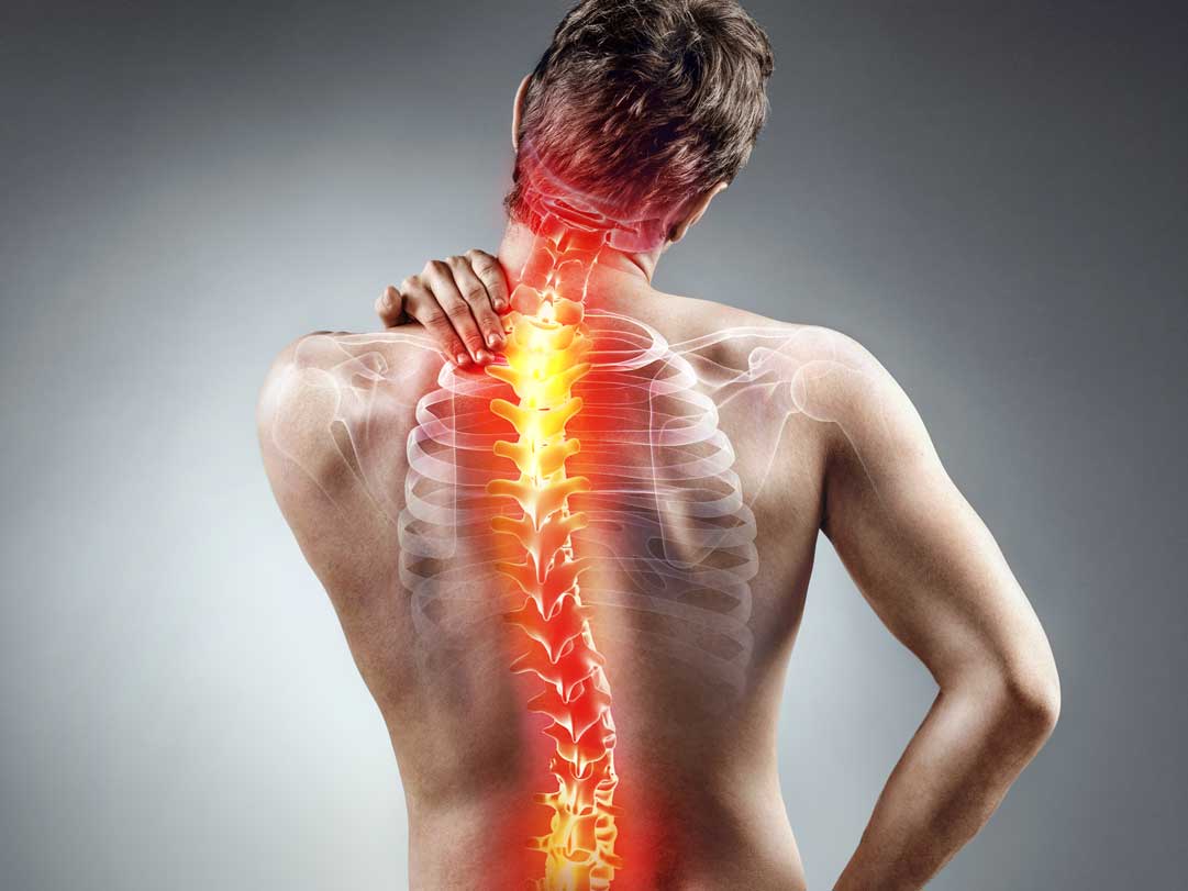 What To Know About Spine Surgery for Scoliosis