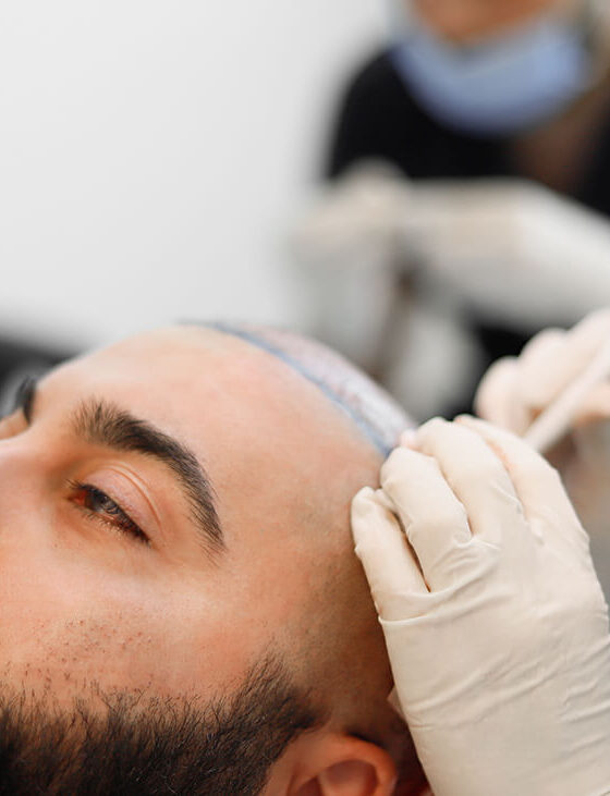 What to Expect During a Hair Transplant Procedure