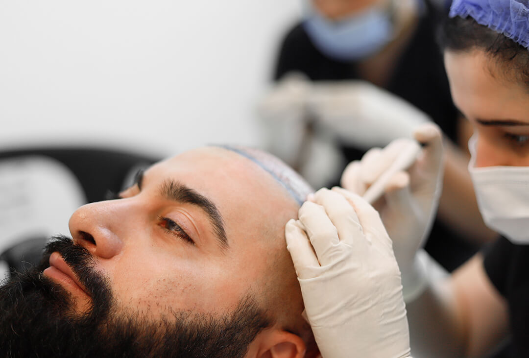 What to Expect During a Hair Transplant Procedure