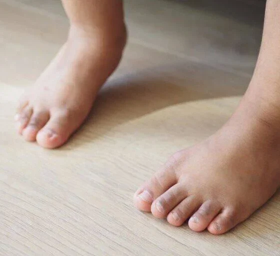 When Surgery for Bunions Necessary?