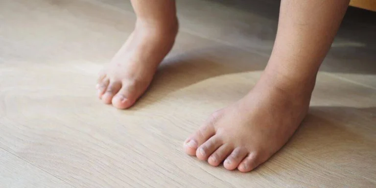 When Surgery for Bunions Necessary?