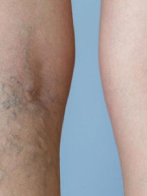 Understanding When to See a Vein Specialist for Varicose Veins
