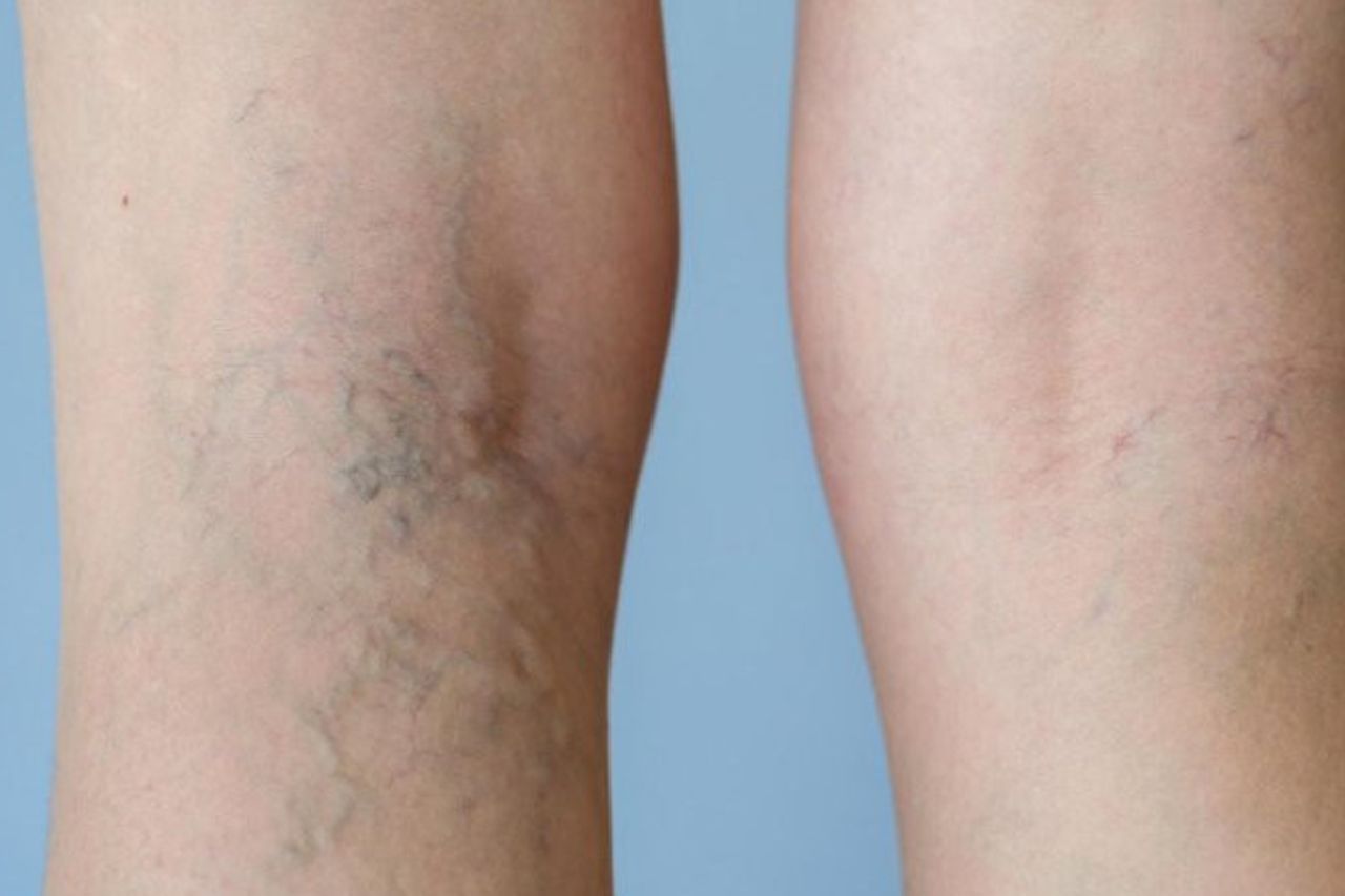 Understanding When to See a Vein Specialist for Varicose Veins